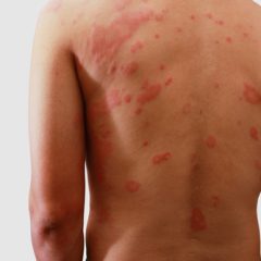 דרמטיטיס אטופית עקרונות הטיפול