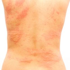 אורטיקריה כרונית: אבחון וטיפול