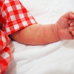 אטופיק דרמטיטיס (אסתמה של העור): הבנה וטיפול