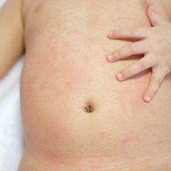 אסתמה של העור בתינוקות