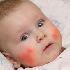 אקזמה בתינוקות