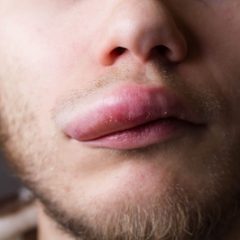 הבצקת האלרגית (האנגיואדמה)