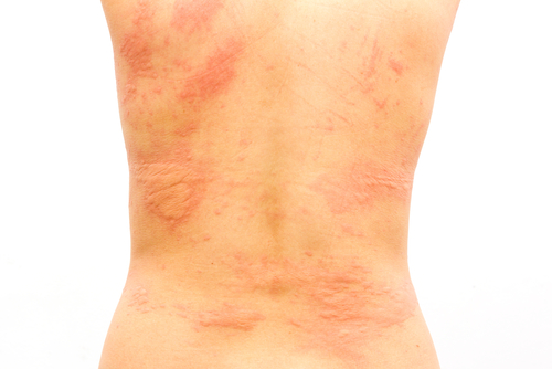 אורטיקריה כרונית: אבחון וטיפול