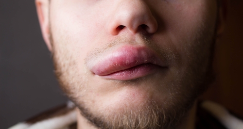 הבצקת האלרגית (האנגיואדמה)